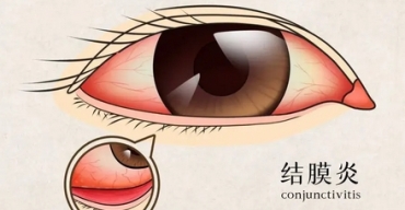 济南养老网教您如何应对过敏性结膜炎